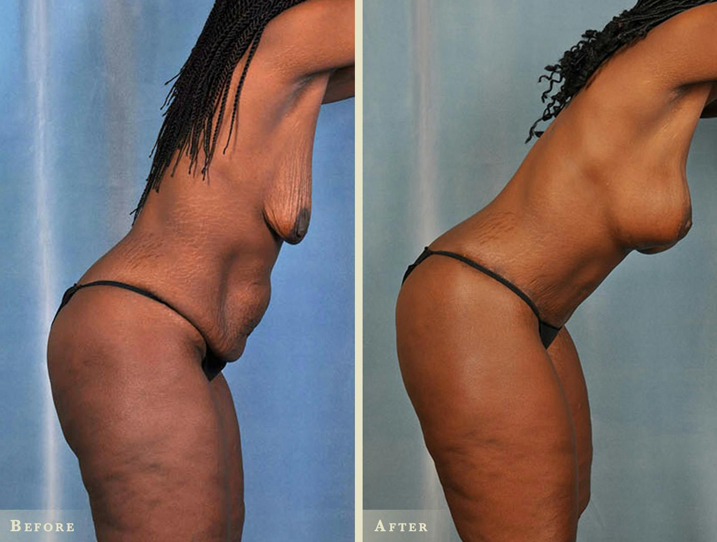 Mommy Makeover Before & After Gallery - Patient 315042 - Image 2