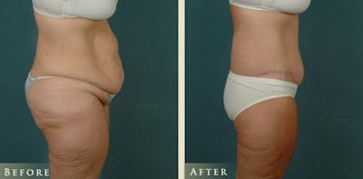 Body Lift Before & After Gallery - Patient 229158 - Image 3