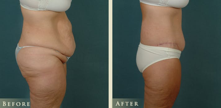Body Lift Before & After Gallery - Patient 229158 - Image 3