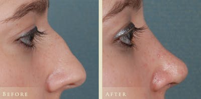 Aesthetic Rhinoplasty Before & After Gallery - Patient 874715 - Image 5