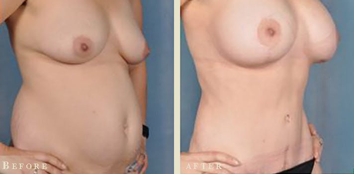 Tummy Tuck Before & After Gallery - Patient 159915 - Image 2