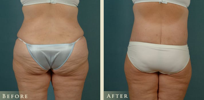 Body Lift Before & After Gallery - Patient 229158 - Image 4