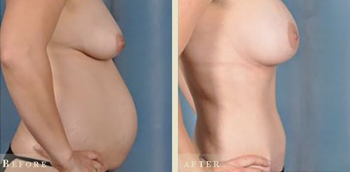 Tummy Tuck Before & After Gallery - Patient 159915 - Image 3