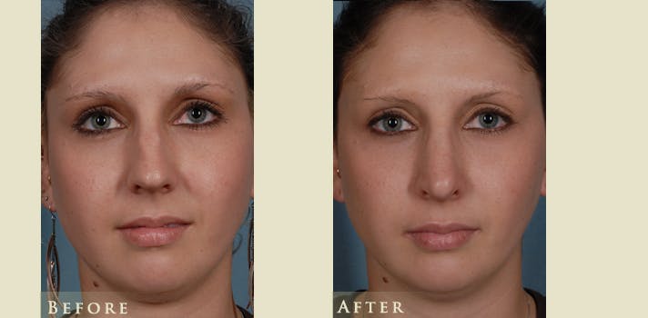 Aesthetic Rhinoplasty Before & After Gallery - Patient 218846 - Image 1