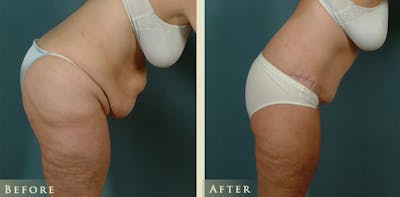 Body Lift Before & After Gallery - Patient 229158 - Image 5