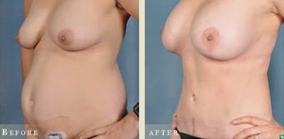 Tummy Tuck Before & After Gallery - Patient 159915 - Image 4