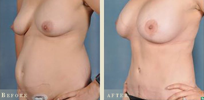 Tummy Tuck Before & After Gallery - Patient 159915 - Image 4