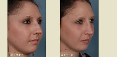 Aesthetic Rhinoplasty Before & After Gallery - Patient 218846 - Image 2