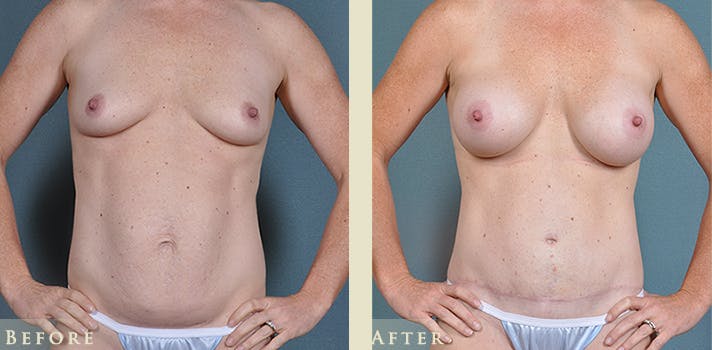 Mommy Makeover Before & After Gallery - Patient 430265 - Image 2
