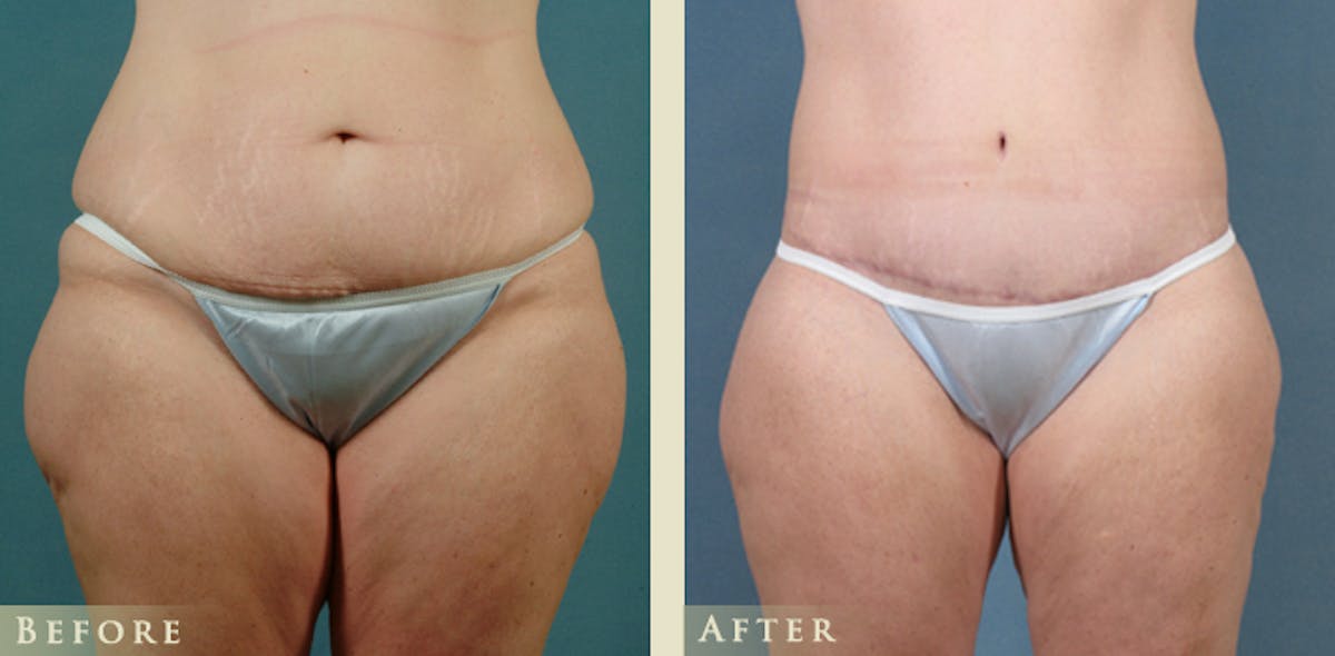 Body Lift Before & After Gallery - Patient 418907 - Image 1