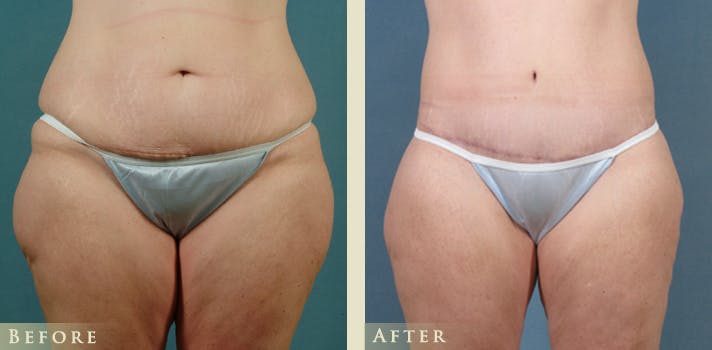 Body Lift Before & After Gallery - Patient 418907 - Image 1