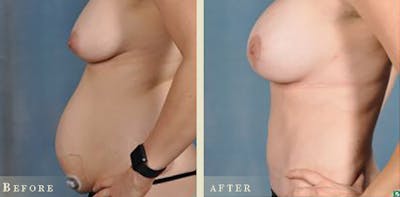 Tummy Tuck Before & After Gallery - Patient 159915 - Image 5
