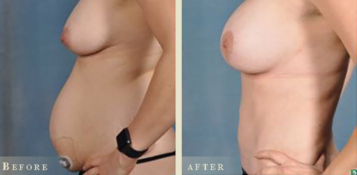 Tummy Tuck Before & After Gallery - Patient 159915 - Image 5