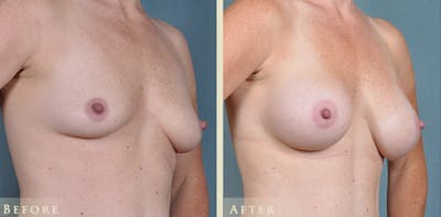 Mommy Makeover Before & After Gallery - Patient 430265 - Image 3
