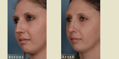 Aesthetic Rhinoplasty Before & After Gallery - Patient 218846 - Image 3