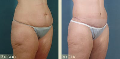 Body Lift Before & After Gallery - Patient 418907 - Image 2