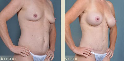 Mommy Makeover Before & After Gallery - Patient 430265 - Image 4