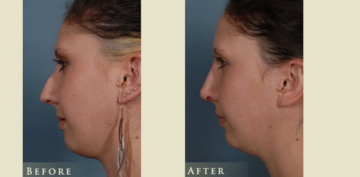Aesthetic Rhinoplasty Before & After Gallery - Patient 218846 - Image 4