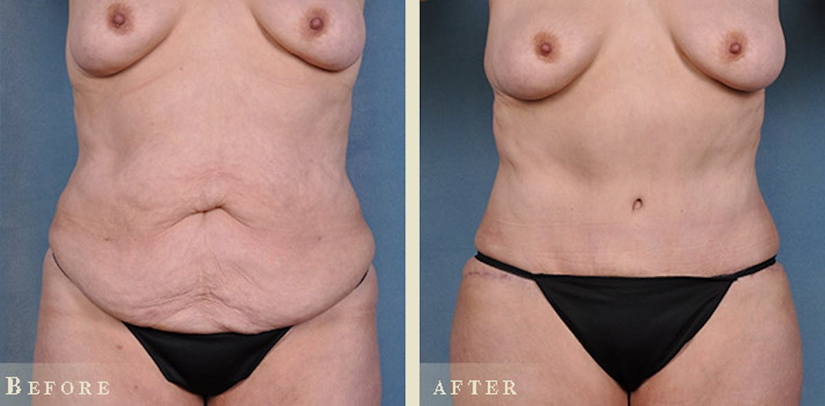 Tummy Tuck Before & After Gallery - Patient 320354 - Image 1