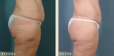 Body Lift Before & After Gallery - Patient 418907 - Image 3