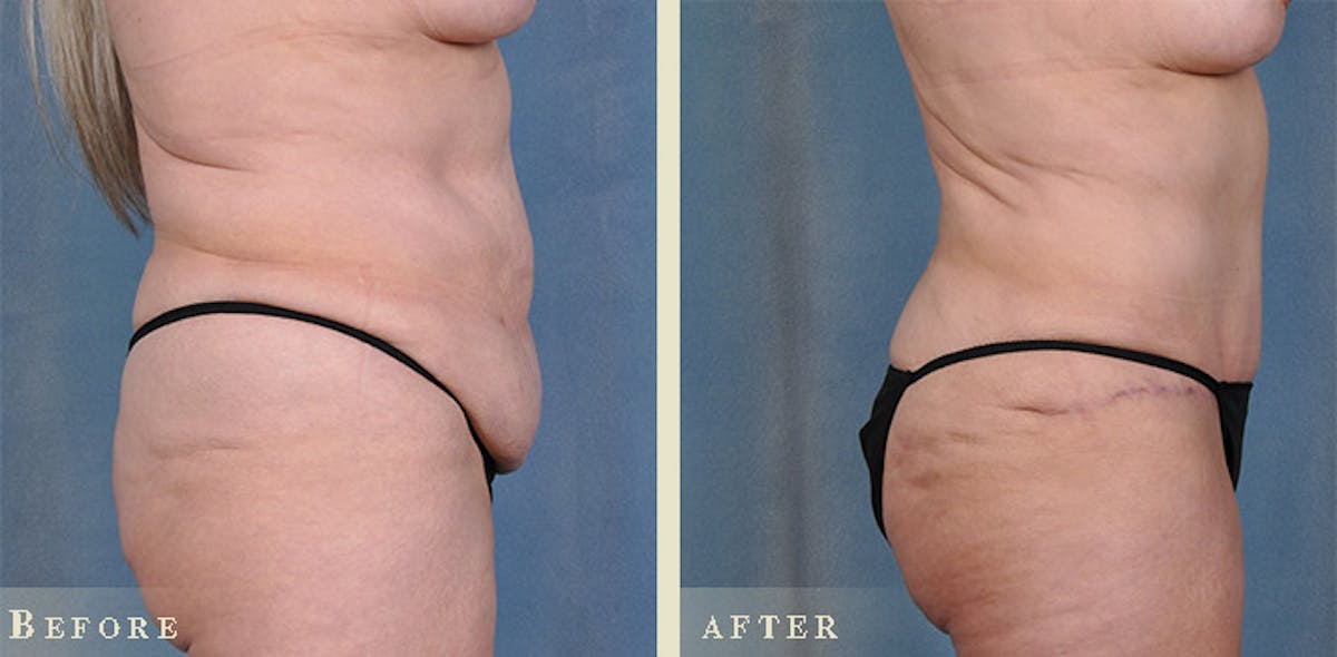 Tummy Tuck Before & After Gallery - Patient 320354 - Image 2