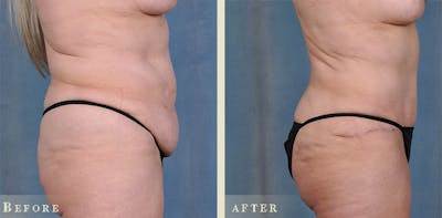 Tummy Tuck Before & After Gallery - Patient 320354 - Image 2