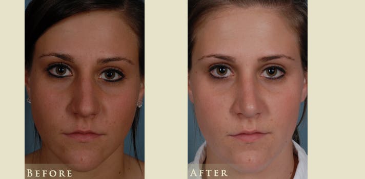 Aesthetic Rhinoplasty Before & After Gallery - Patient 278936 - Image 1