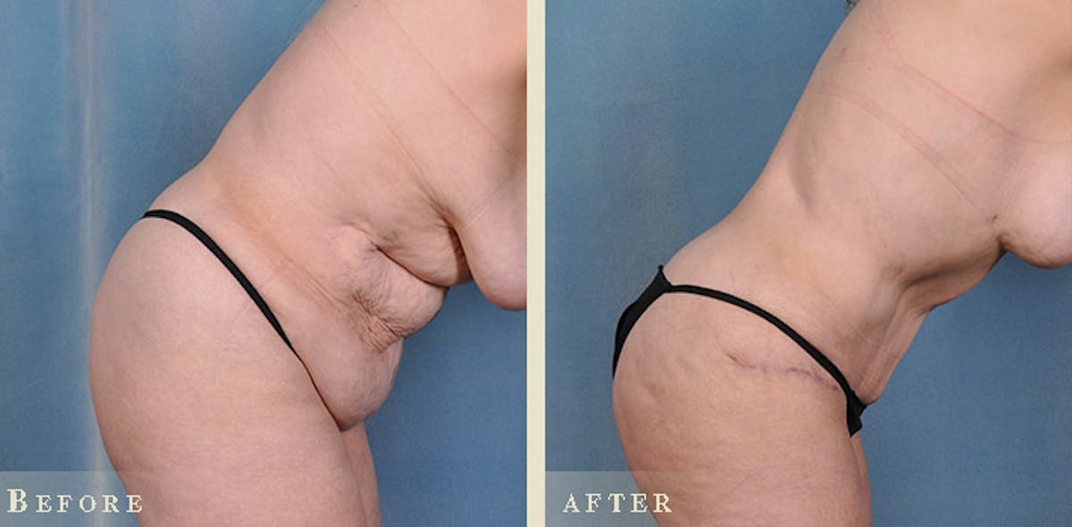 Tummy Tuck Before & After Gallery - Patient 320354 - Image 3