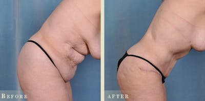 Tummy Tuck Before & After Gallery - Patient 320354 - Image 3