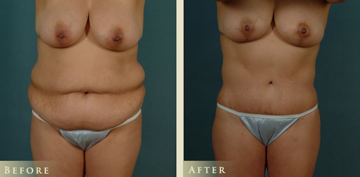 Body Lift Before & After Gallery - Patient 235061 - Image 1