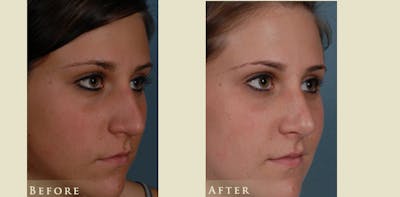 Aesthetic Rhinoplasty Before & After Gallery - Patient 278936 - Image 2