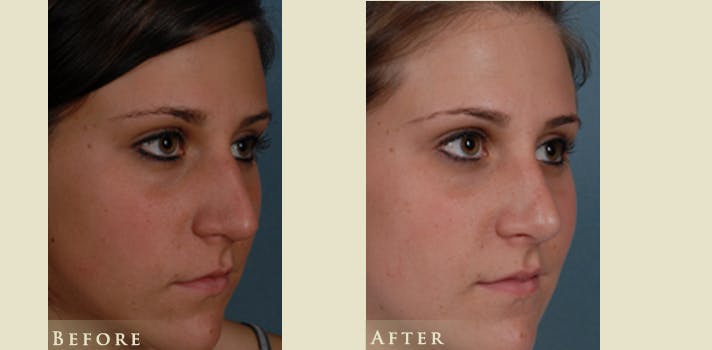 Aesthetic Rhinoplasty Before & After Gallery - Patient 278936 - Image 2