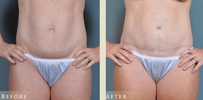 Mommy Makeover Before & After Gallery - Patient 430265 - Image 7