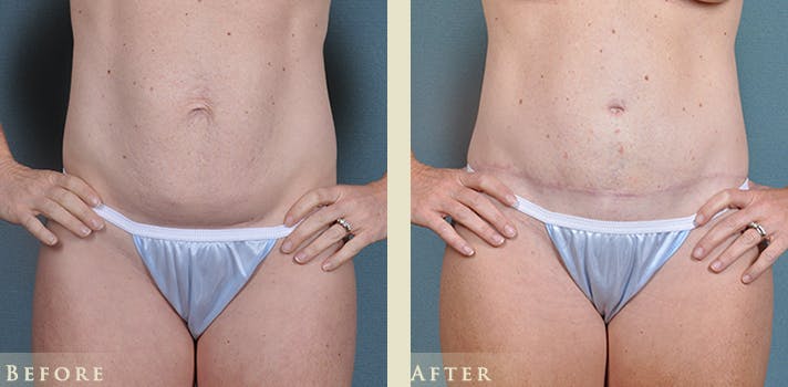 Mommy Makeover Before & After Gallery - Patient 430265 - Image 7