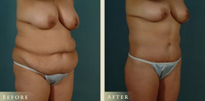 Body Lift Before & After Gallery - Patient 235061 - Image 2