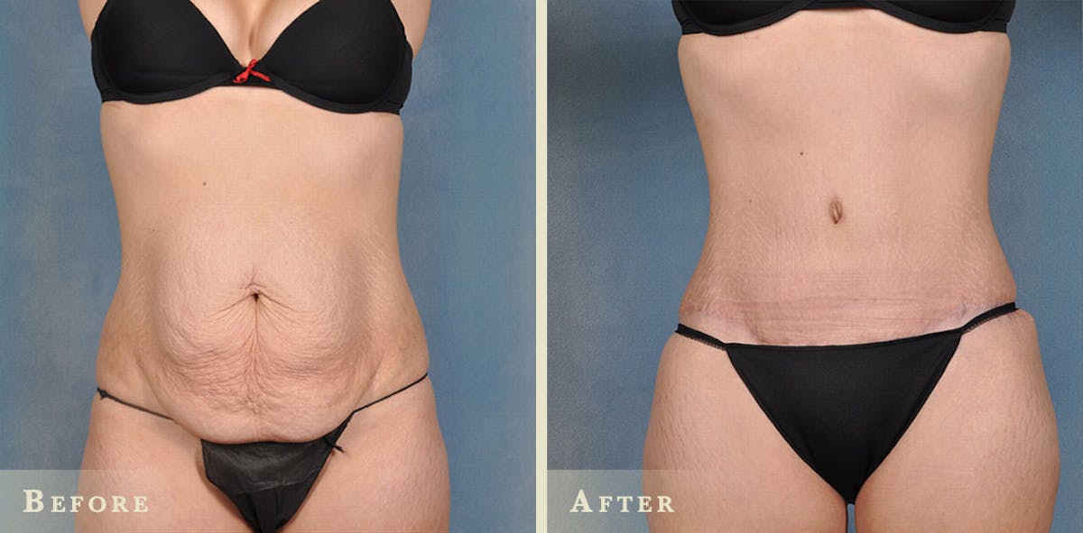 Female Liposuction Before & After Gallery - Patient 322478 - Image 1