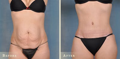 Female Liposuction Before & After Gallery - Patient 322478 - Image 1