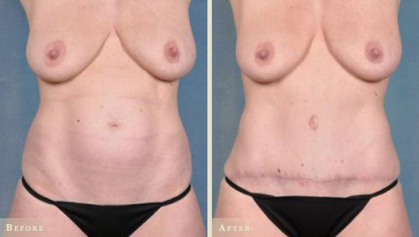 Tummy Tuck Before & After Gallery - Patient 350464 - Image 1