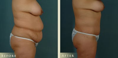 Body Lift Before & After Gallery - Patient 235061 - Image 3