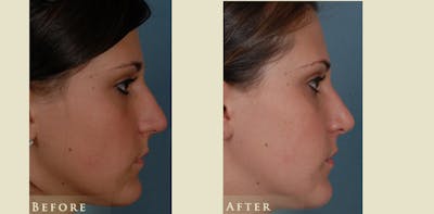 Aesthetic Rhinoplasty Before & After Gallery - Patient 278936 - Image 3
