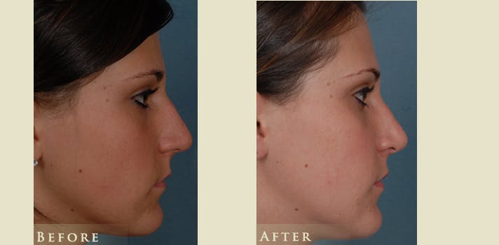 Aesthetic Rhinoplasty Before & After Gallery - Patient 278936 - Image 3