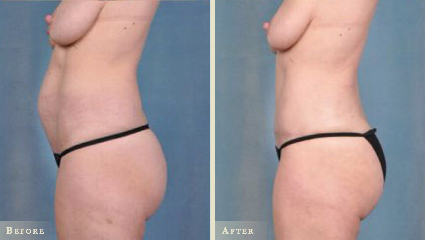 Tummy Tuck Before & After Gallery - Patient 350464 - Image 2