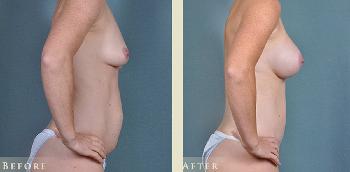 Mommy Makeover Before & After Gallery - Patient 430265 - Image 9