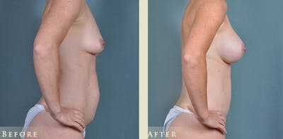 Mommy Makeover Before & After Gallery - Patient 430265 - Image 9