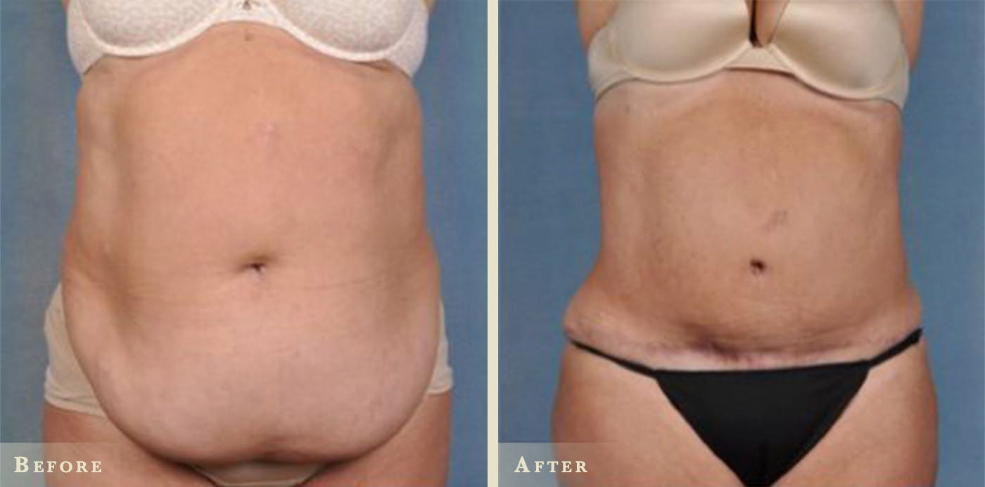 Tummy Tuck Before & After Gallery - Patient 306408 - Image 1