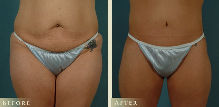 Body Lift Before & After Gallery - Patient 332306 - Image 1