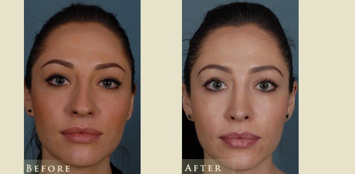 Aesthetic Rhinoplasty Before & After Gallery - Patient 179433 - Image 1