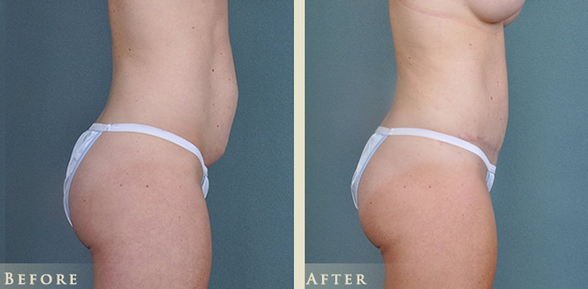 Mommy Makeover Before & After Gallery - Patient 430265 - Image 10