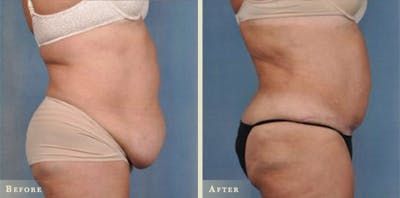 Tummy Tuck Before & After Gallery - Patient 306408 - Image 2