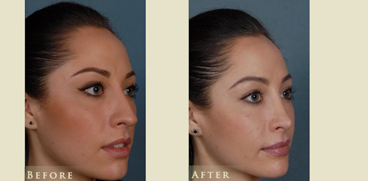 Aesthetic Rhinoplasty Before & After Gallery - Patient 179433 - Image 2